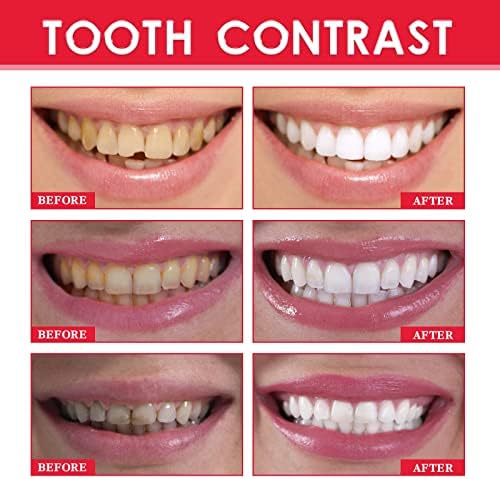 שיניים פניניות נינג שן הלבנת שן בהבהרת שן הבהרה הוסרת כתמים