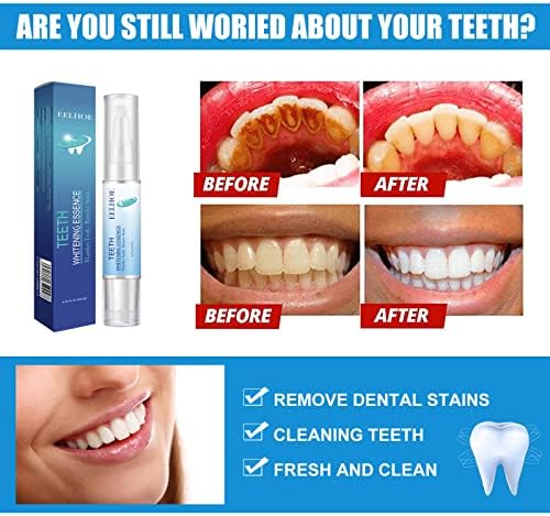 מהות הלבנת שיניים, הלבנת שיניים הובנת עט שיניים מסירת כתמים ללבין ולהבהיר שיניים עם ג'ל הלבנת שיניים
